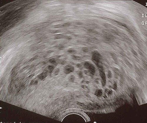 Complete hydatidiform mole on transabdominal ultrasound