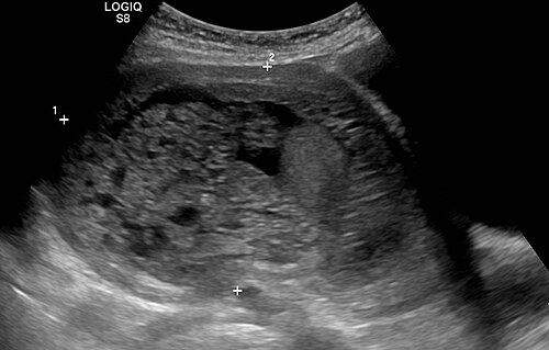 Molar pregnancy with heterogeneous vesicular uterine contents and caliper measurement