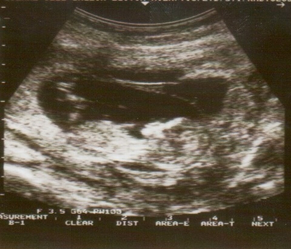Retroplacental hematoma on ultrasound